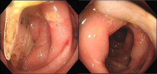 Colonoscopy identified a non-retrievable foreign body impacting the lumen of the sigmoid colon.