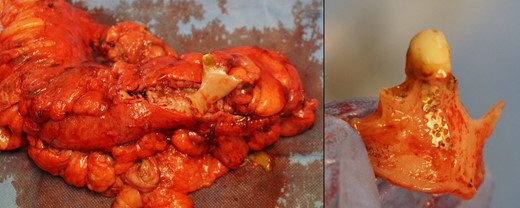 22 cm of resected sigmoid colon contained the lost partial denture showing impaction and perforation into the sigmoid mesocolon.