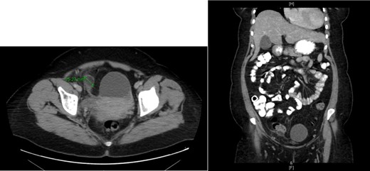 CT showing epiploic appendagitis.