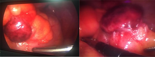 A laparoscopic view of gangrenous sigmoid appendagitis after adhesiolysis from abdominal wall.
