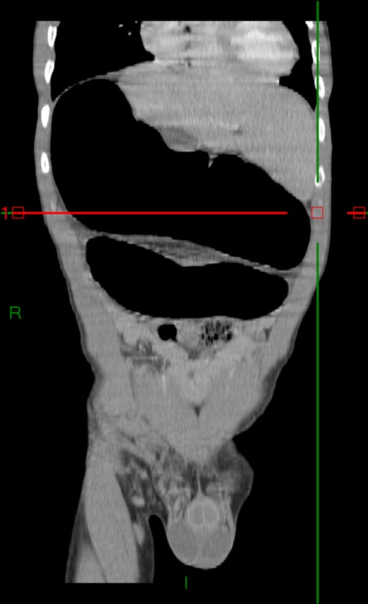 Abdominal-pelvic CT—coronal plane: colonic volvulus associated with a transmesocolic hernia with transmural necrosis of the colon sigmoid.