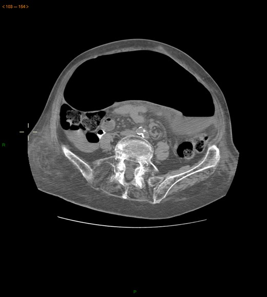 Abdominal-pelvic CT—transverse plane: colonic volvulus associated with a transmesocolic hernia with transmural necrosis of the colon sigmoid.