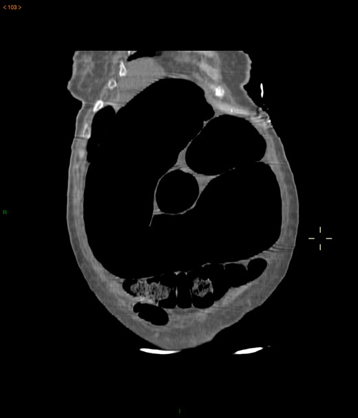Abdominal-pelvic CT—coronal plane: colonic volvulus associated with a transmesocolic hernia with transmural necrosis of the colon sigmoid.