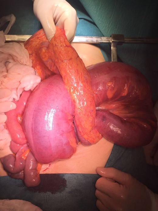 Intraoperative image: colon sigmoid with transmural necrosis in a strangulated transverse transmesocolic and transomental (great omentum) hernia.