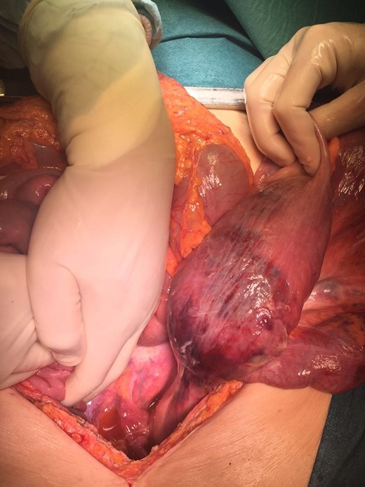 Intraoperative image: volvulus of colon sigmoid with transmural necrosis in a strangulated transverse transmesocolic and transomental (great omentum) hernia.
