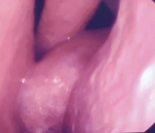 Endoscopic view of the left antrochoanal polyp.