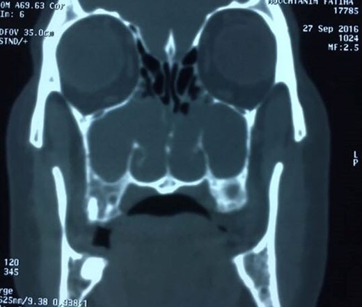 CT scan showing bilateral antrochoanal polyp.