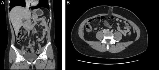 (A) Contrast-enhanced CT, revealing an inflamed appendix. (B) Contrast-enhanced CT, surrounded by heterogeneous inflamed fat.
