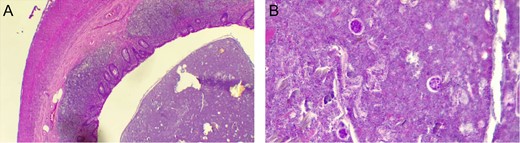(A) Polymorphonuclear inflammatory infiltrate in the appendix wall. (B) Trophozoites of E. histolytica in the appendicular wall.