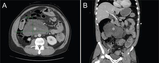 CT of the abdomen and pelvis showing a 10.2 × 14.1 × 14.1 cm collection of stool, fluid and gas along the right colon.