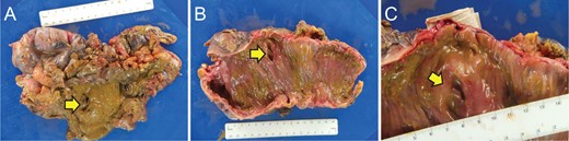 Gross Pathology of Surgical Specimen. (A) External surface of the resected bowel. (B) Internal surface of the resected bowel at low magnification. (C) Internal surface of the resected bowel at high magnification. Yellow arrows indicate cecal perforation.