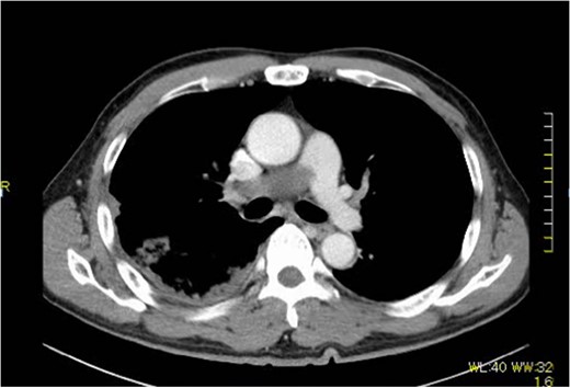 Extensive contrast-deficient images ae present from the pulmonary artery trunk to the right pulmonary artery.