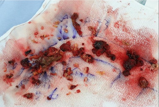 Macro findings of the pulmonary artery show sarcoma and thrombus.