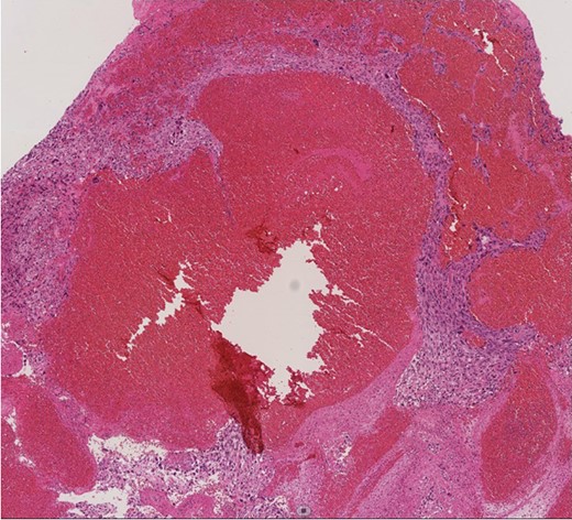 Histopathological image (×100). Histologic analysis of the specimen shows high-grade undifferentiated sarcoma due to polymorphism with mitoses and a polychromatic inner lining. Necrotic tissue and thrombi are also present in the tumor, with invasion into the fibrous intima of the pulmonary artery.