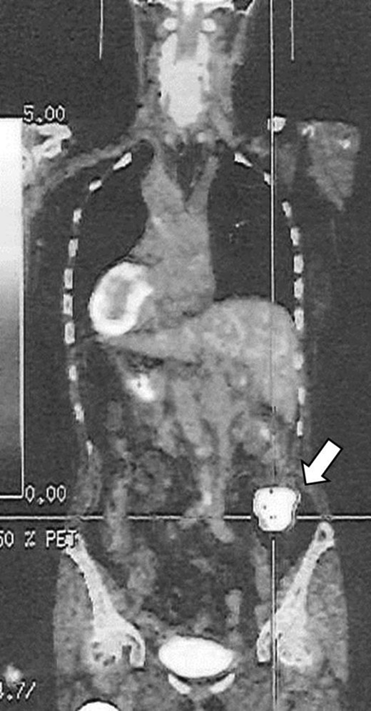 PET/CT image showed FDG uptake at the ascending colon (arrow).