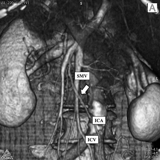 3D-CT image: There was no right colic artery and ileocolic artery was located ventral to superior mesenteric vein (arrow). And there was angioplany. SMV: Superior mesenteric vein ICA: Ileocecal artery ICV: Ileocecal vein.