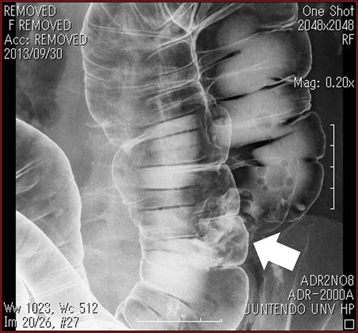 Barium enema revealed an elevated lesion in the ascending colon (arrow).