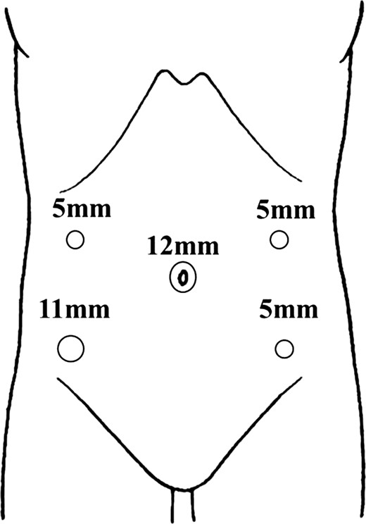 Intraoperative view: trocar placement for laparoscopic right colectomy in this patient.