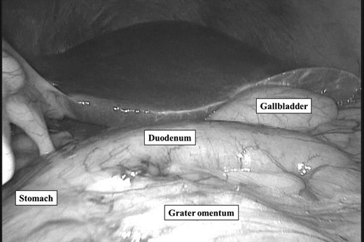 Laparoscopic view: the duodenum had weak fixation to the retroperitoneum and malrotation. The beginning and second portion of the duodenum were abnormal position.
