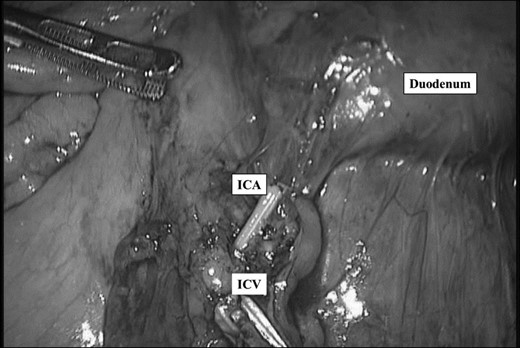 After ligation of ileocecal artery and vein. ICA: Ileocecal artery ICV: Ileocecal vein.