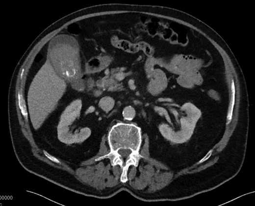 CT with dense heterogeneous gallbladder contents and cholelithiasis.
