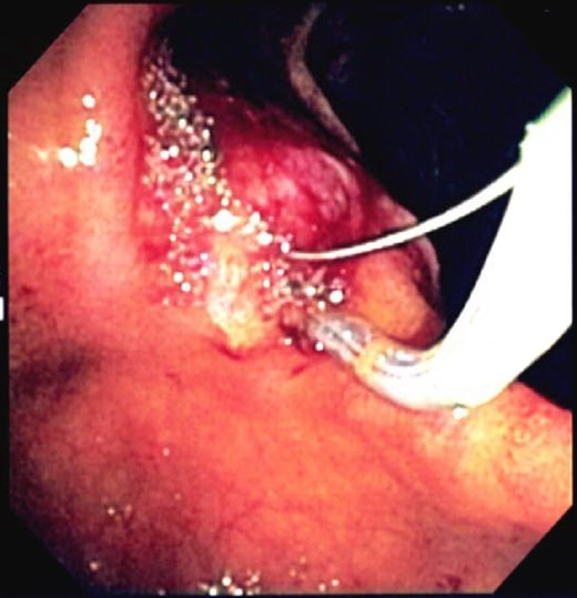 Endoscopic image of ERCP with hemorrhagic contents being removed.