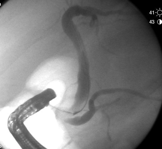 Cholangiogram after CBD sweep with obstructed cystic duct.
