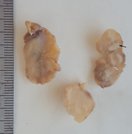 Macroscopic view: an illustrative case of lymph node tuberculosis with cheese-like appearance of the caseous necrosis (arrow).