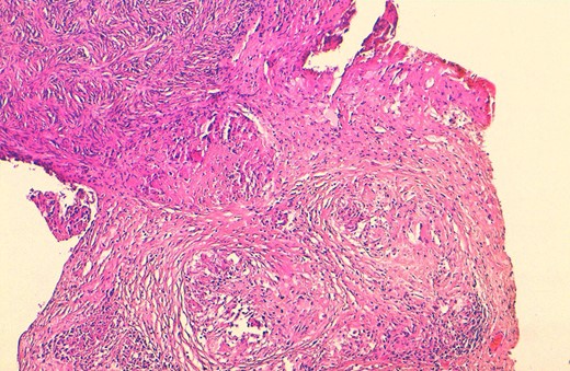Histological view showing ovarian parenchyma with granulomatous lesions and caseous necrosis (H&E × 100).