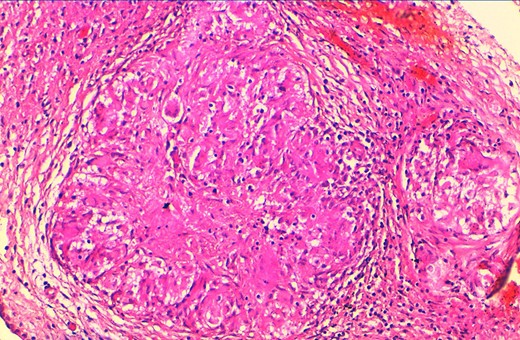 At higher magnification, tuberculosis granulomas include epithelioid and giant cells, plasma cells and caseous necrosis, along with fibrotic changes (H&E × 200).
