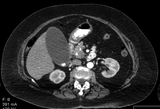 Contrast enhanced CT with pancreatic protocol. Pancreatic head mass.