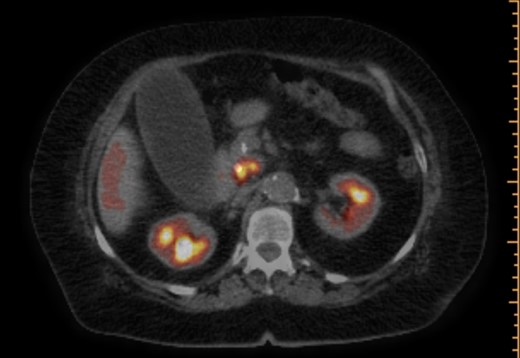 PET/CT scan. Pancreatic head mass with fludeoxyglucose (FDG) uptake.