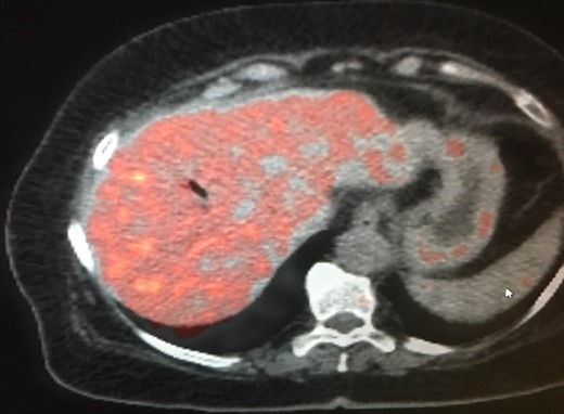 PET/CT scan. No FDG uptake in liver.