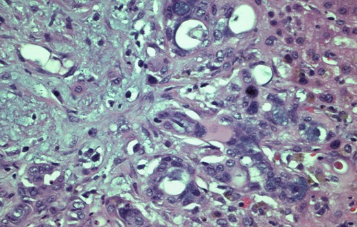 H&E stain, 400Ă— original magnification. Wedge Liver biopsy. Histology diagnostic of pancreatic adenocarcinoma.