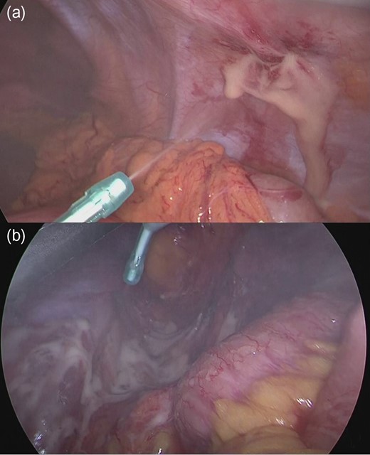 (a) Apply the barrier to the port insertion area. (b) Spraying the peeled surface of pelvic cavity in the Hartmann operation.