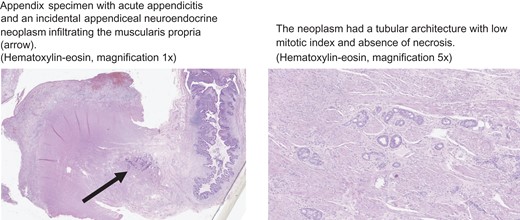 Histopathological images of the appendix (hematoxylin-eosin).