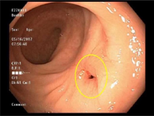 Side-to-side colorectal anastomosis with stricture (circle).