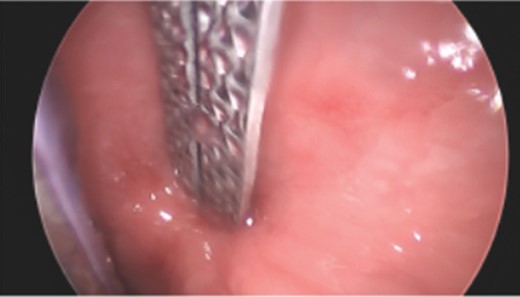 Endo GIA stapler traversing two limbs of anastomosis.