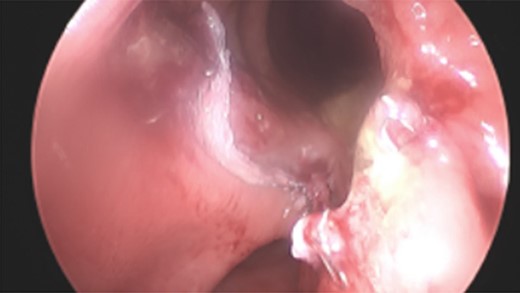 Post-stricturoplasty.