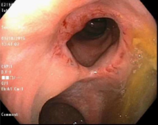 Patent colorectal anastomosis 6 months post-stricturoplasty.