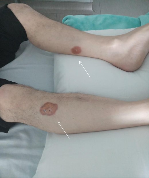 Necrobiosis lipoidica: Yellow-brown skin lesions with indurated borders located on both lower legs.
