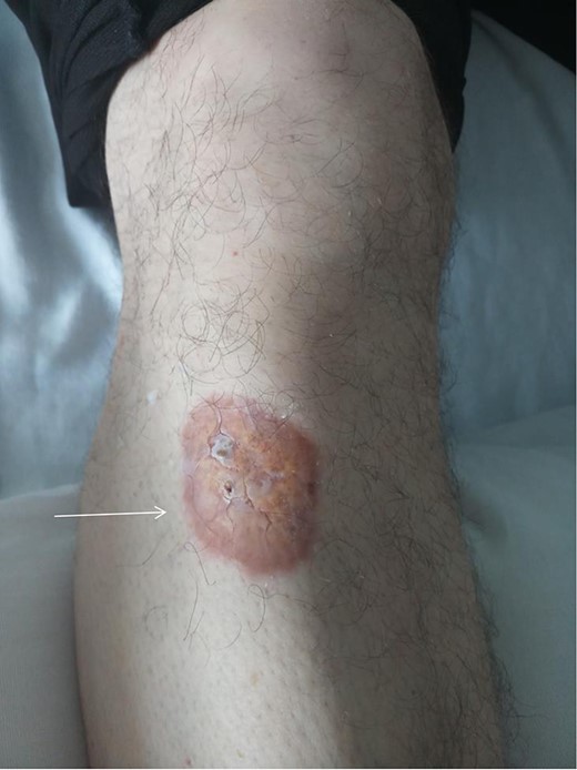 The lesion (necrobiosis lipoidica) on the right lower leg located on the pretibial area.