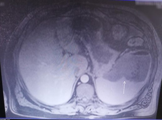 CECT investigation revealed abscess and air presence in the upper pole of the spleen.