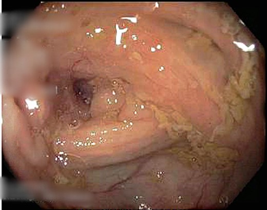 Narrowed segment of ascending colon.