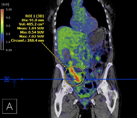 PET demonstrating intense metabolic uptake in thickened ascending colon.