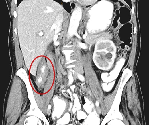 CT demonstrating thickened segment of ascending colon.