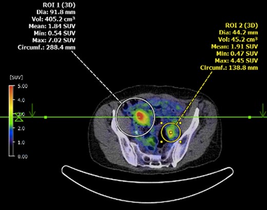 Axial PET showing separate focus of avidity in left pelvic side-wall.