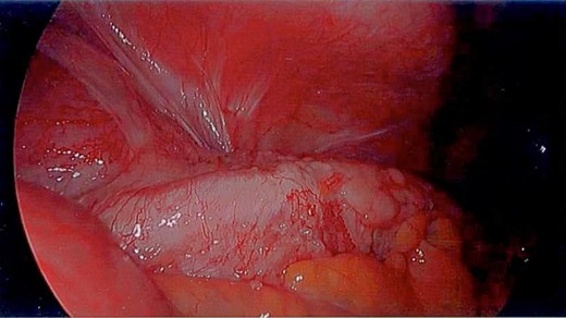 Laparoscopy—diseased segment of ascending colon.
