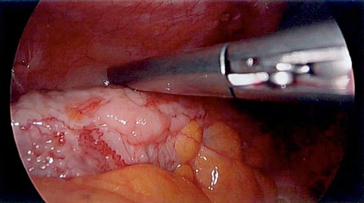 Laparoscopy—close-up view of white lathered appearance.