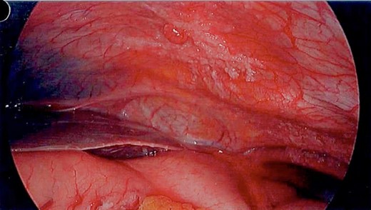 Laparoscopy—peritoneal disease in right upper quadrant.